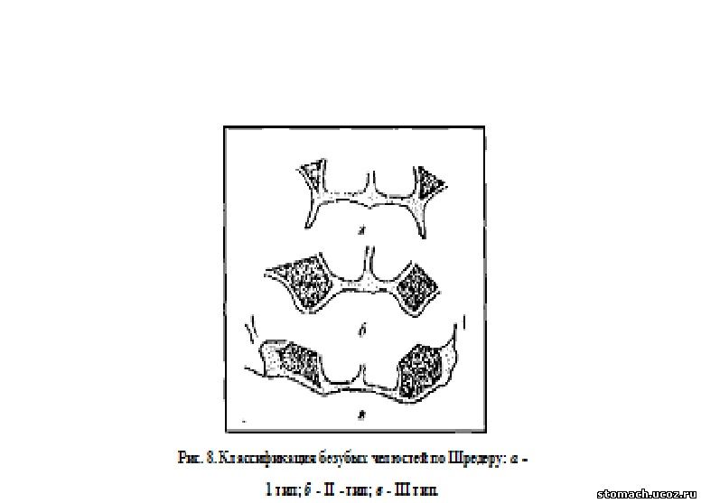 Классификация челюстей по шредеру. 1 Тип по Шредеру. Классификация беззубых челюстей по Шредеру. Классификация по Шредеру. Тип челюсти по Шредеру.